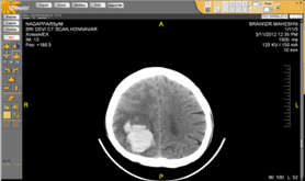 Brain CT Scan Brain CT Scan